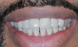 Thumbnail control image for Close-up of a smiling mouth showing teeth with noticeable gaps and natural facial hair around the lips.