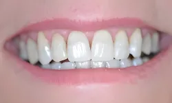Thumbnail control image for Close-up of a smiling person's mouth showing natural white teeth and pink lips.