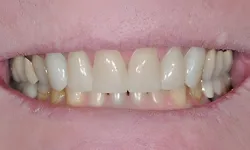 Thumbnail control image for Close-up of a smile showing dental crowns with varying shades and natural teeth discoloration.