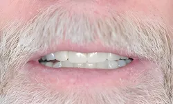 Thumbnail control image for Close-up of an older man's mouth with white beard and slightly parted teeth.