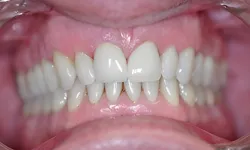 Thumbnail control image for Close-up of upper and lower teeth showing dental crowns on front teeth with natural surrounding teeth.
