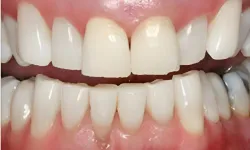 Thumbnail control image for Close-up of stained, discolored upper and lower teeth showing dental problems before treatment.