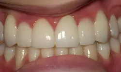 Thumbnail control image for Close-up of healthy, clean human teeth and gums with natural color and alignment under bright light.