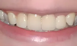 Thumbnail control image for Close-up of a smiling mouth showing clean, well-aligned white teeth and healthy pink lips.