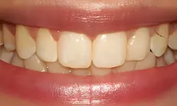 Thumbnail control image for Close-up of smiling mouth showing slightly uneven teeth with minor discoloration and small cracks on a tooth.