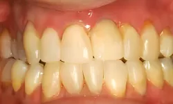 Thumbnail control image for Close-up of human teeth showing slight discoloration and gum details in a natural mouth open smile.
