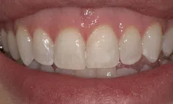 Thumbnail control image for Close-up of a smiling mouth showing clean, white upper front teeth and pink gums.
