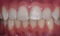 Thumbnail control image for Close-up of upper and lower front teeth showing slight discoloration and dental plaque buildup on gums.