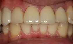 Thumbnail control image for Close-up of upper and lower teeth showing dental alignment and natural gums in a healthy mouth