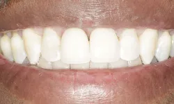 Thumbnail control image for Close-up of a person smiling showing clean, white teeth and healthy gums.