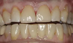 Thumbnail control image for Close-up of teeth with visible plaque buildup and discoloration on upper and lower teeth.