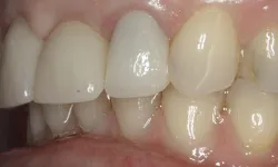 Thumbnail control image for Close-up of upper and lower teeth showing dental crowns with slight color mismatch on natural teeth.