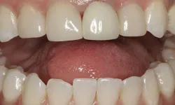 Thumbnail control image for Close-up of upper and lower teeth showing natural dental alignment and healthy gums with visible tongue.