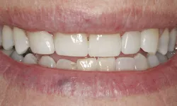 Thumbnail control image for Close-up of a smile showing natural teeth with slight gaps and visible lips with a small bruise.