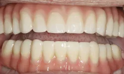 Thumbnail control image for Close-up of upper and lower artificial teeth with healthy gums and natural dental appearance.