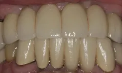 Thumbnail control image for Close-up of upper and lower artificial dental crowns showing realistic tooth restoration and color variations.