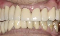 Thumbnail control image for Close-up of upper and lower dentures with natural tooth color and some gold crowns visible.