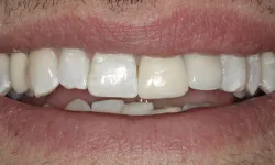 Thumbnail control image for Close-up of a smiling mouth showing teeth with discoloration and uneven alignment.