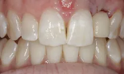 Thumbnail control image for Close-up of teeth showing dental discoloration, chipped front tooth, and worn enamel on upper front teeth.