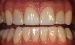 Thumbnail control image for Close-up of healthy, clean upper and lower teeth showing natural enamel shine and pink gums.