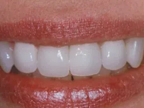 Close-up of a smiling mouth with clean, white teeth and natural lips.