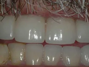 Close-up of upper and lower teeth showing dental issues including discoloration and plaque buildup.