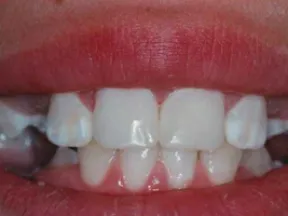 Close-up of a smile showing misaligned, crowded, and irregular baby teeth with red lips.