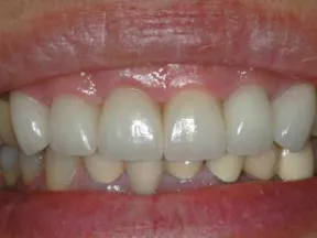 Close-up of a smiling mouth showing clean, white upper teeth and slightly darker lower teeth.
