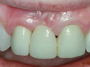 Close-up of upper front teeth with a missing central incisor revealing gum tissue area.