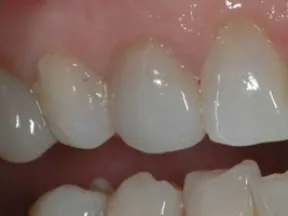 Close-up of clean, natural upper and lower teeth with a small gap between the front teeth