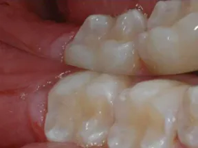Close-up of healthy human molars with detailed surface texture and gums visible in the mouth