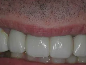 Close-up of a mouth showing white, artificial teeth and natural gums in dim lighting.