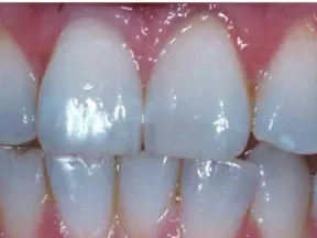 Close-up of clean, healthy human teeth and gums with natural shine and slight gaps between incisors.