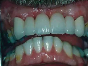 Close-up of a person's mouth showing teeth with dental crowns and plaque buildup on natural teeth.