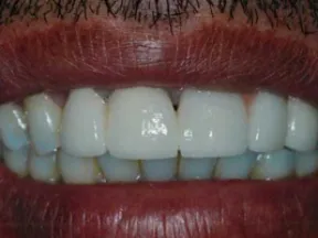 Close-up of a smiling mouth showing clean white teeth and dark lips with facial hair above.