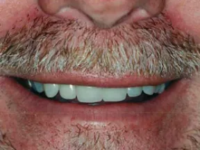 Close-up of a man’s smiling mouth with visible teeth and a gray mustache and beard.