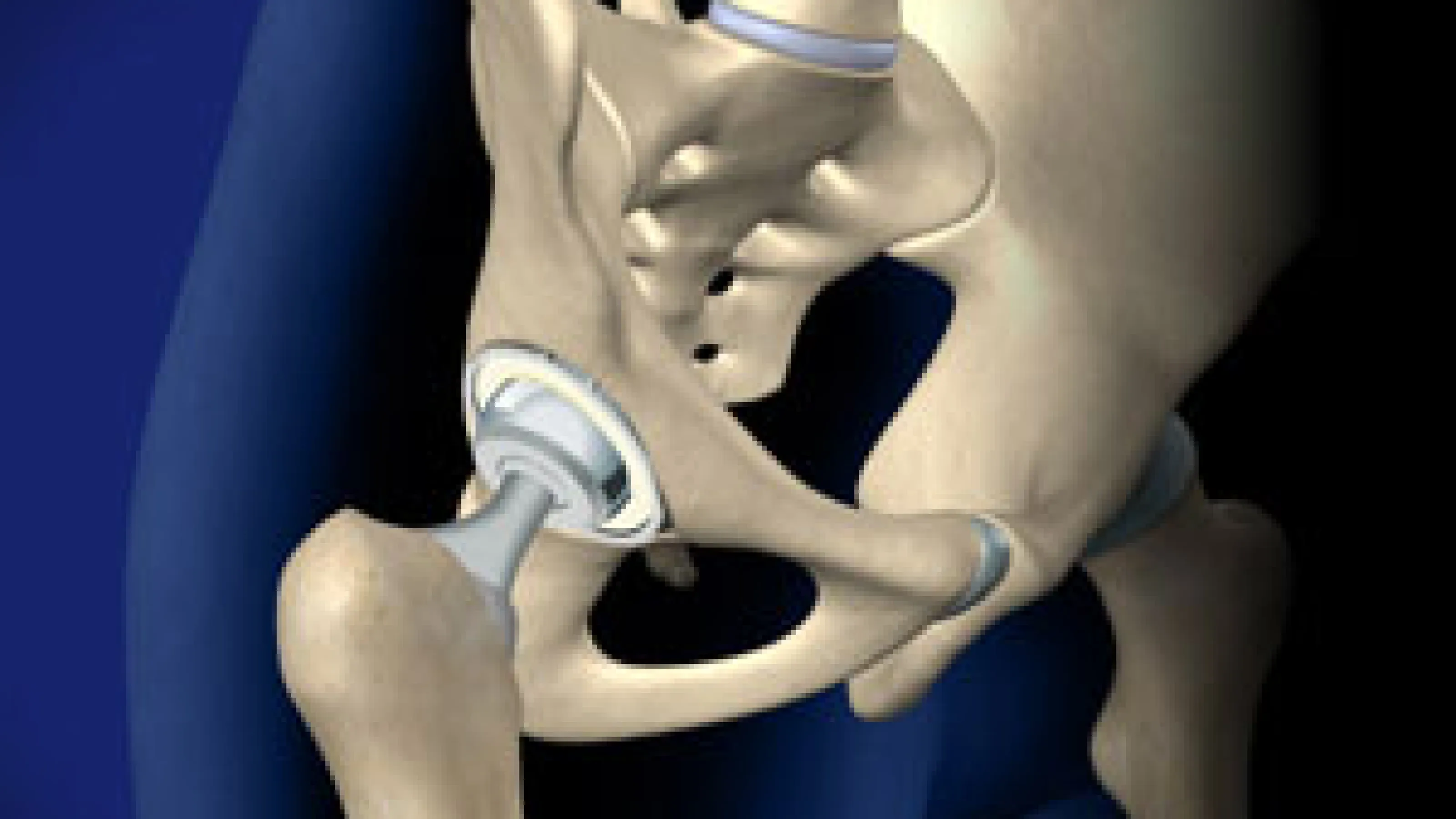 Orthopedic Hip Replacement Surgeons Near Me in Lexington, KY