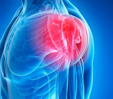 Image for Bursitis vs Tendinitis: Differences Between Common Shoulder Conditions