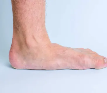 Image for Managing Flatfoot and Arch Pain