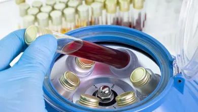 Platelet-Rich Plasma in Early Knee Osteoarthritis