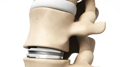 Body Weight and Disc Herniation