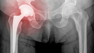 The Value of Innovation in Joint Replacement