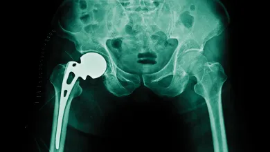 X-ray showing a hip replacement with a metal prosthesis fitted on the left hip bone.