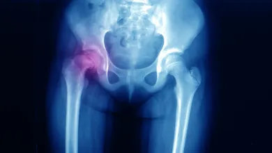 xray hip dislocation
