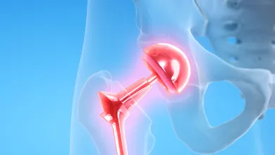 3D illustration of a hip joint replacement implant inside a semi-transparent pelvis showing metal prosthetic components.