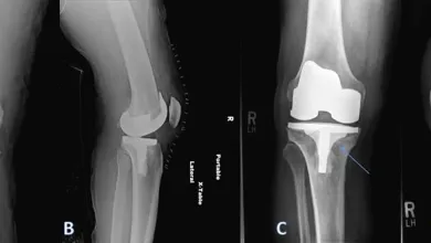 X-ray images showing stages before and after right knee replacement surgery with prosthetic implants.