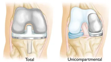 an image involving total and partial knee replacement