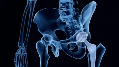 Know the outcomes of your total joint implant system