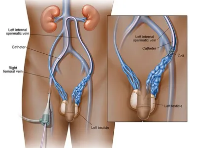 Medical illustration showing catheter insertion in the left internal spermatic vein for embolization near the left testicle.