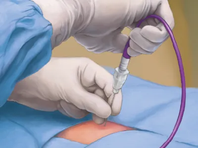 Medical professional in gloves inserting a needle with a purple tube into patient's skin during procedure.